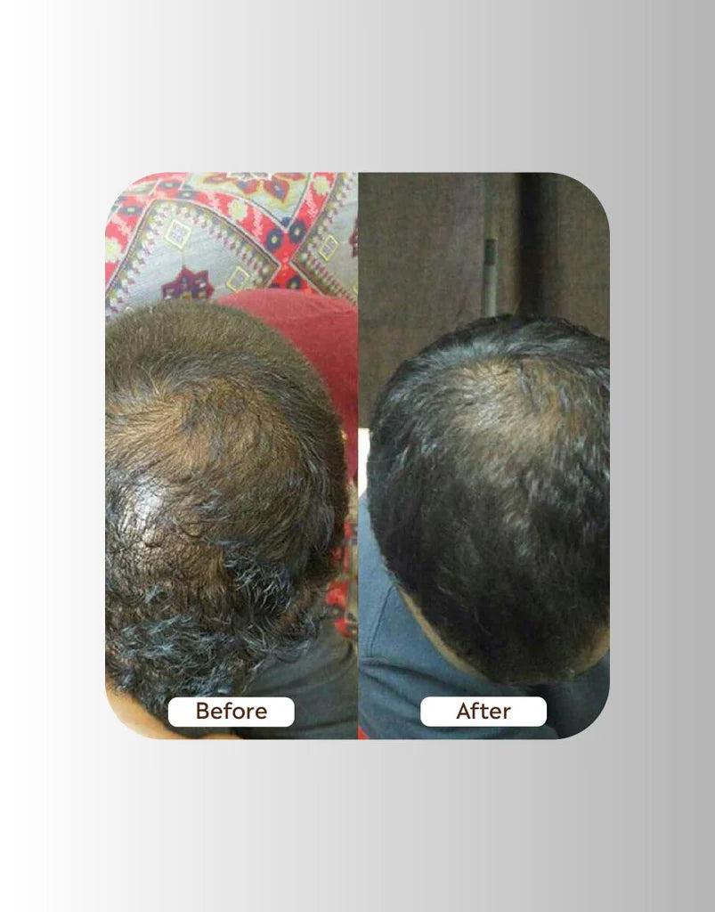 Rosemary Oil + Shampoo - Bundle with Free Delivery